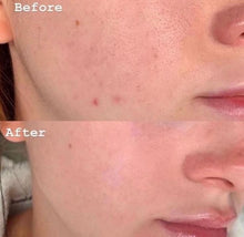 Load image into Gallery viewer, Oily / Acne Skincare Regime